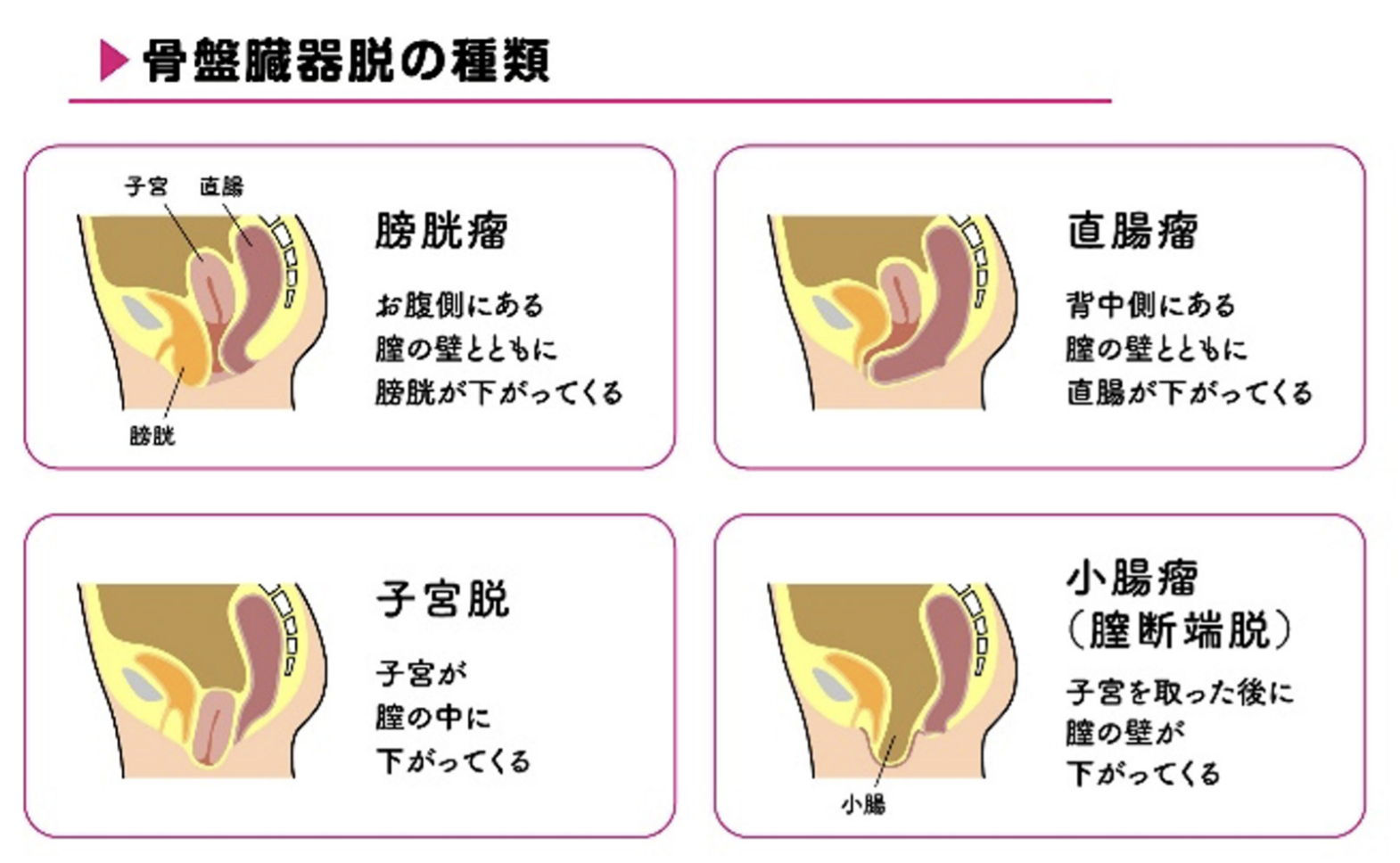 月経帯 骨盤臓器脱 | メープル木更津クリニック